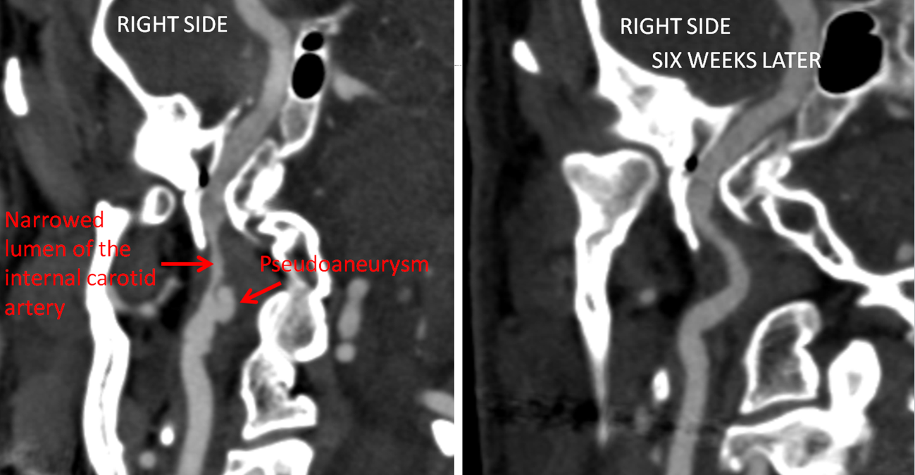 pulsatile-tinnitus-carotid-artery-dissection-neuroangio